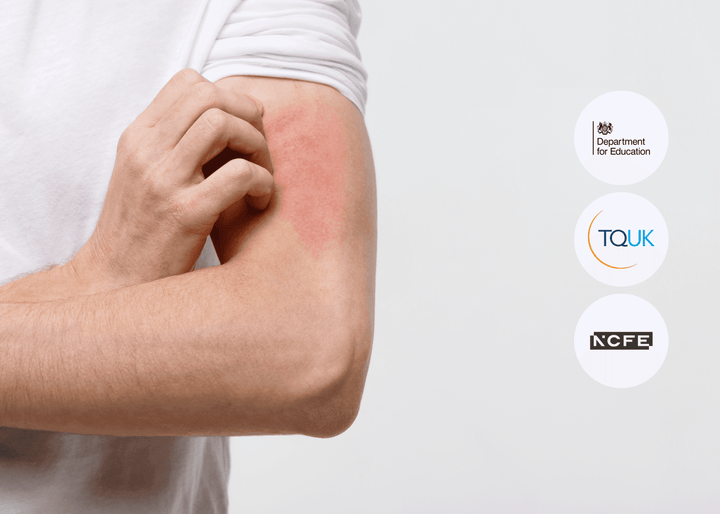 Close-up of a service worker scratching a red, irritated rash on their upper arm, highlighting the impact of allergic reactions in the workplace.